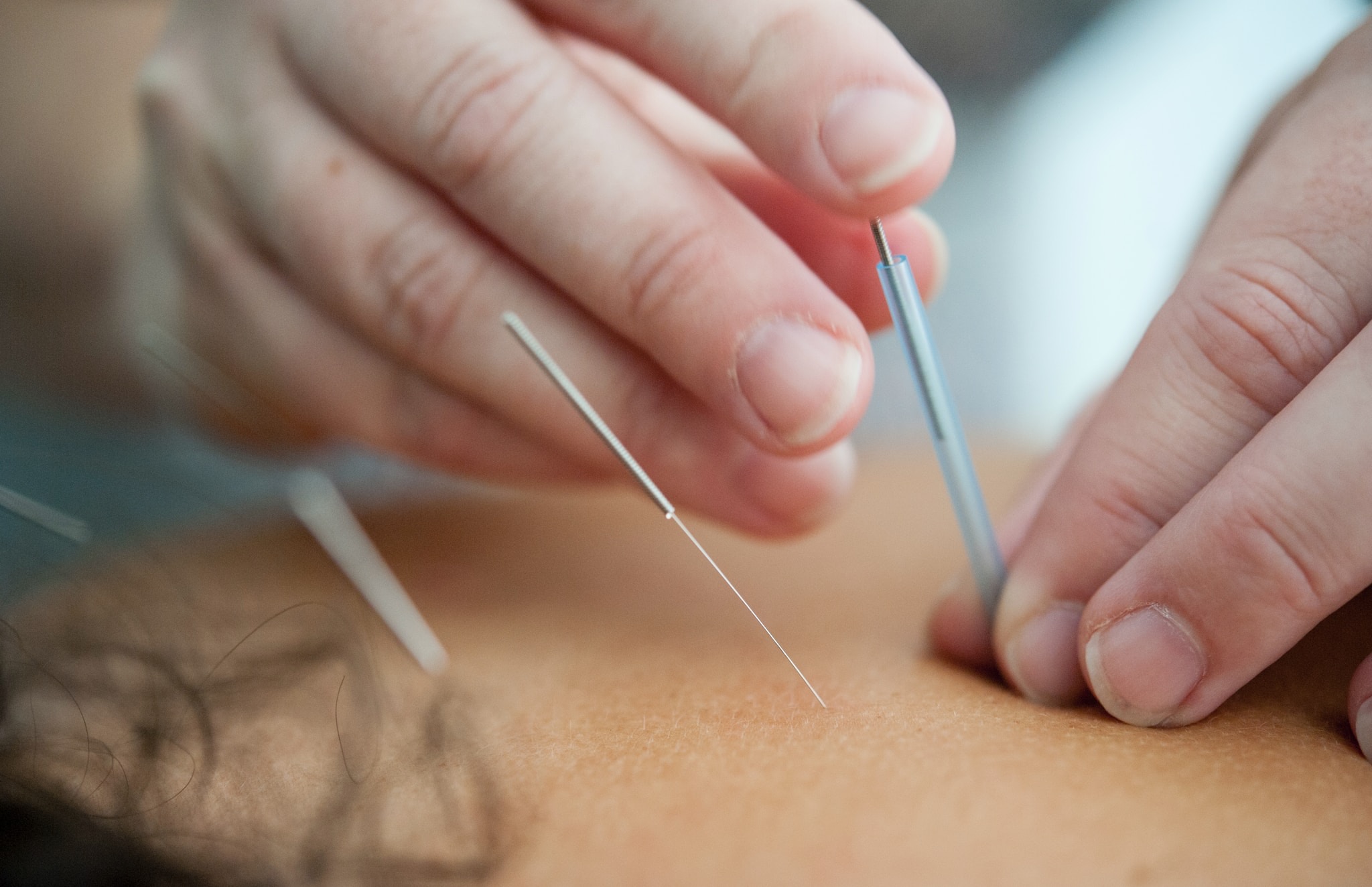 Dry Needling: How It Works to Relieve Pain